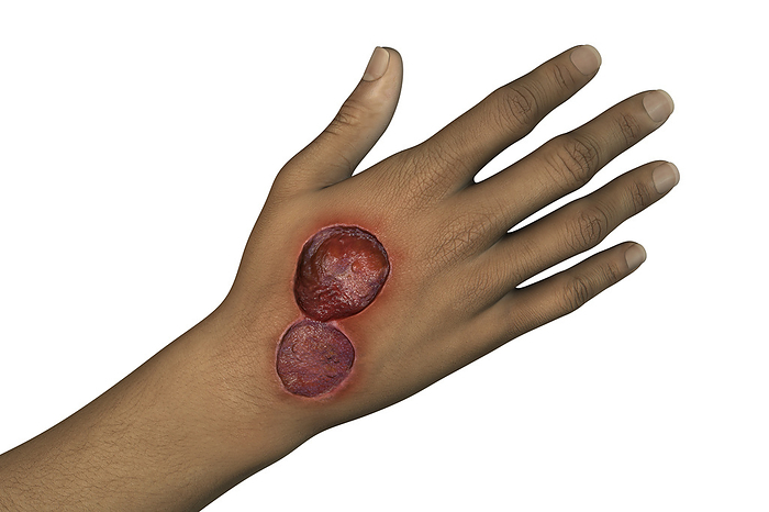 Buruli ulcer on a hand, illustration Illustration of a buruli ulcer, a skin disease caused by Mycobacterium ulcerans bacteria, on a hand., by KATERYNA KON SCIENCE PHOTO LIBRARY