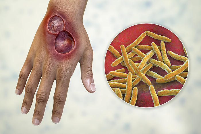 Buruli ulcer and Mycobacterium ulcerans, illustration Illustration of a buruli ulcer on a hand with a close up view of Mycobacterium ulcerans, the bacterium that causes the disease., by KATERYNA KON SCIENCE PHOTO LIBRARY