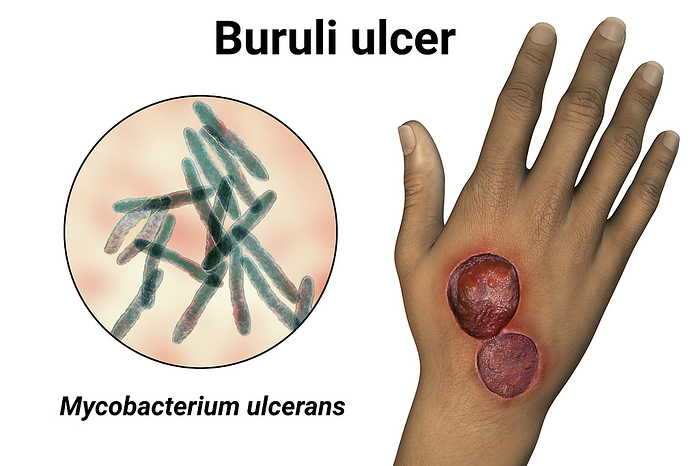 Buruli ulcer and Mycobacterium ulcerans, illustration Illustration of a buruli ulcer on a hand with a close up view of Mycobacterium ulcerans, the bacterium that causes the disease., by KATERYNA KON SCIENCE PHOTO LIBRARY