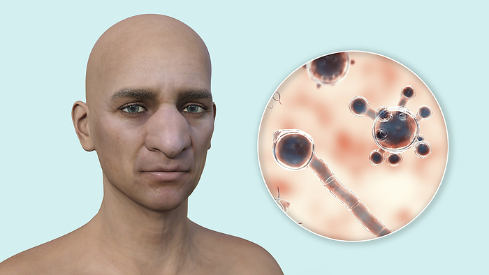 Rhinofacial conidiobolomycosis and fungus, illustration Illustration of rhinofacial conidiobolomycosis in a man with a close up view of the microscopic fungus Conidiobolus coronatus, the causative agent of the disease. This chronic mycosis affects the nose and face. The infection occurs when the fungus enters the body through a cut or wound on the skin or through the nose. The fungus then grows in the tissues, causing inflammation and swelling, which can lead to deformities in the nose and face. The infection is usually slow growing and painless, but it can cause discomfort and affect the patient s quality of life. Symptoms of rhinofacial conidiobolomycosis include facial swelling, redness, and thickening of the skin, nasal obstruction, and discharge. The infection can also cause vision problems if it spreads to the eyes. It is a rare condition, but it can occur in immunocompromised individuals, those with underlying medical conditions, or those who live in areas with high fungal exposure., by KATERYNA KON SCIENCE PHOTO LIBRARY