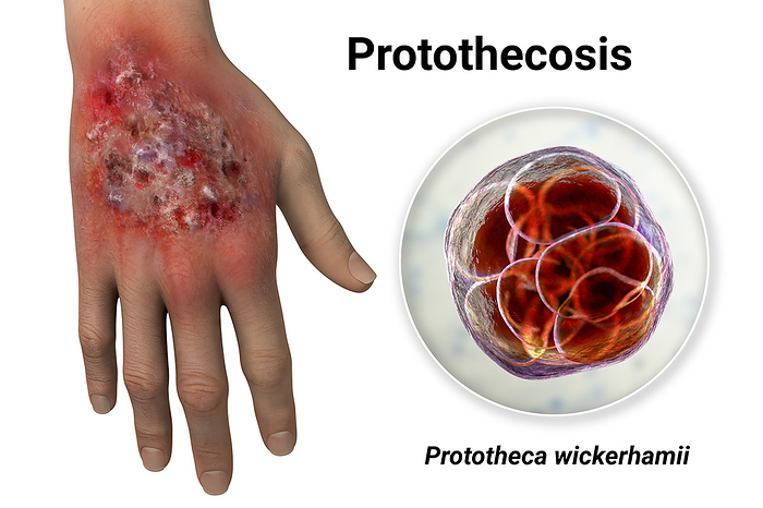 Protothecosis infection on a human hand, illustration Protothecosis infection on a human hand with a close up view of Prototheca wickerhamii green algae, the causative agent of the disease, computer illustration. Prototheca wickerhamii species, and can cause skin lesions, ulcers, and other symptoms. Prototheca is a type of green alga. The infection can affect humans, animals, and plants, and is usually acquired through contact with contaminated soil or water. Symptoms of Protothecosis can vary depending on the severity of the infection and the area of the body affected. In the case of a hand infection, symptoms may include skin lesions, ulcers, pain, swelling, and redness. Treatment typically involves antifungal medication and surgical removal of the infected tissue. However, Protothecosis can be difficult to treat, and recurrence is common., by KATERYNA KON SCIENCE PHOTO LIBRARY