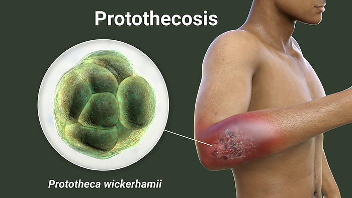 Protothecosis infection on a human elbow, illustration Protothecosis infection on a human elbow with a close up view of Prototheca wickerhamii green algae, the causative agent of the disease, computer illustration. Prototheca wickerhamii species, and can cause skin lesions, ulcers, and other symptoms. Prototheca is a type of green alga. The infection can affect humans, animals, and plants, and is usually acquired through contact with contaminated soil or water. Symptoms of Protothecosis can vary depending on the severity of the infection and the area of the body affected. In the case of a hand infection, symptoms may include skin lesions, ulcers, pain, swelling, and redness. Treatment typically involves antifungal medication and surgical removal of the infected tissue. However, Protothecosis can be difficult to treat, and recurrence is common., by KATERYNA KON SCIENCE PHOTO LIBRARY