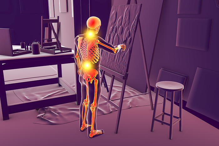 Artist with back and neck pain, illustration Illustration of a male artist with highlighted skeleton painting on canvas in his studio while experiencing back and neck pain, which are common musculoskeletal disorders among artists., by KATERYNA KON SCIENCE PHOTO LIBRARY