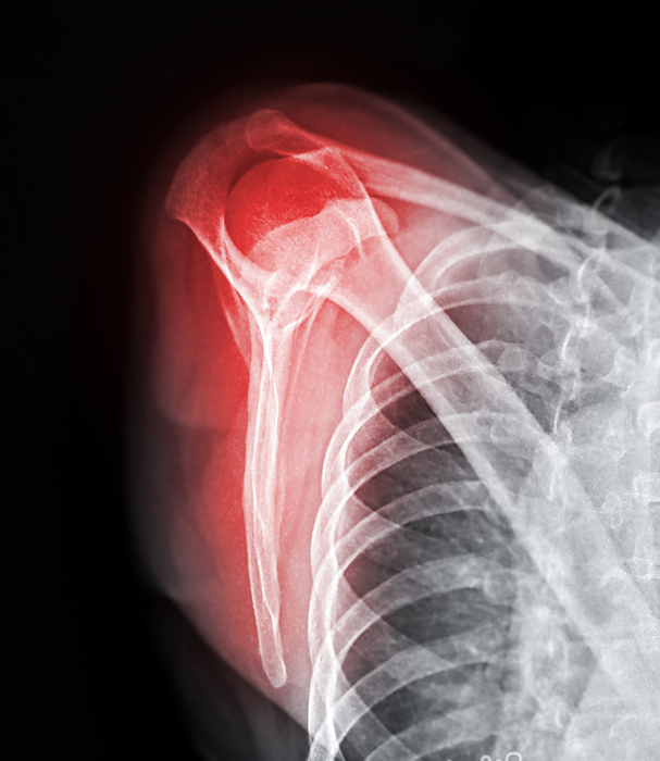 Fractured shoulder, X ray Fractured shoulder, coloured X ray., by SAMUNELLA SCIENCE PHOTO LIBRARY