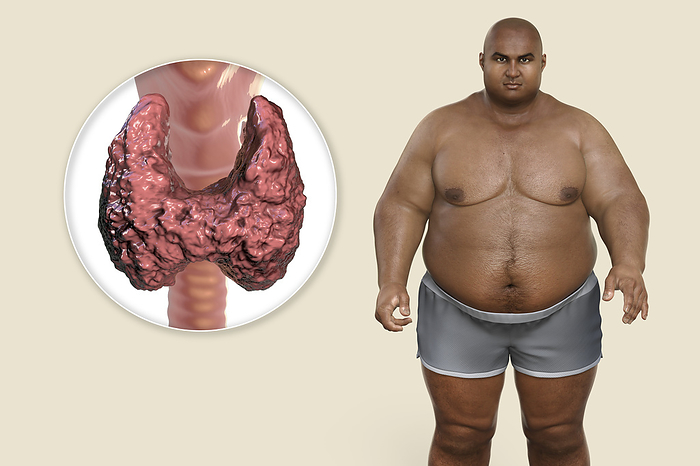 Thyroid diseases and obesity, conceptual illustration Association between thyroid diseases and obesity. Conceptual computer illustration depicting an overweight patient with their thyroid gland., by KATERYNA KON SCIENCE PHOTO LIBRARY