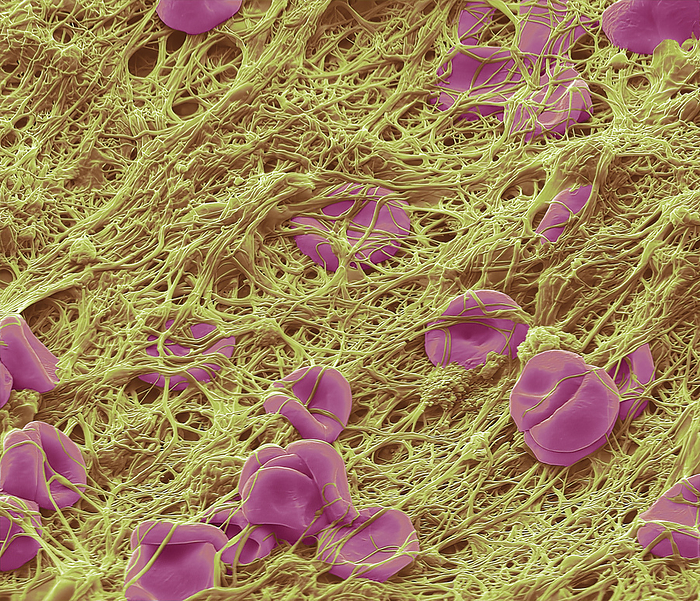 Blood clot, SEM Blood clot. Coloured scanning electron micrograph  SEM  of red blood cells  erythrocytes  trapped in a fibrin mesh  yellow . This image shows the internal surface of a PICC line. A PICC  peripherally inserted central catheter  line is used to give chemotherapy or other treatments such as liquid nutrition. The production of fibrin is triggered by cells called platelets, activated when a blood vessel is damaged. The fibrin binds the various blood cells together, forming a solid structure called a blood clot. A blood clot is a normal response, preventing an excessive loss of blood. However, inappropriate clotting is a major cause of heart attacks and strokes. Magnification x 4000 at 10cm wide, by STEVE GSCHMEISSNER SCIENCE PHOTO LIBRARY
