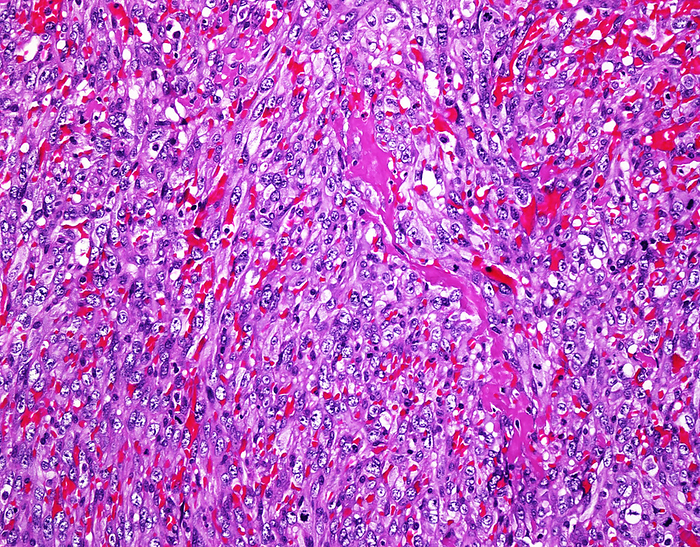 Angiosarcoma, light micrograph Angiosarcoma, light micrograph. Primary sarcomas of the heart are exceedingly rare. Angiosarcoma of the heart makes up almost 40  of all cardiac sarcomas. It is an aggressive malignant  cancerous  neoplasm that shows vascular or lymphatic endothelial differentiation. This image shows high grade, plump tumour cells with abundant eosinophilic cytoplasm lining anastomosing vascular spaces., by WEBPATHOLOGY SCIENCE PHOTO LIBRARY