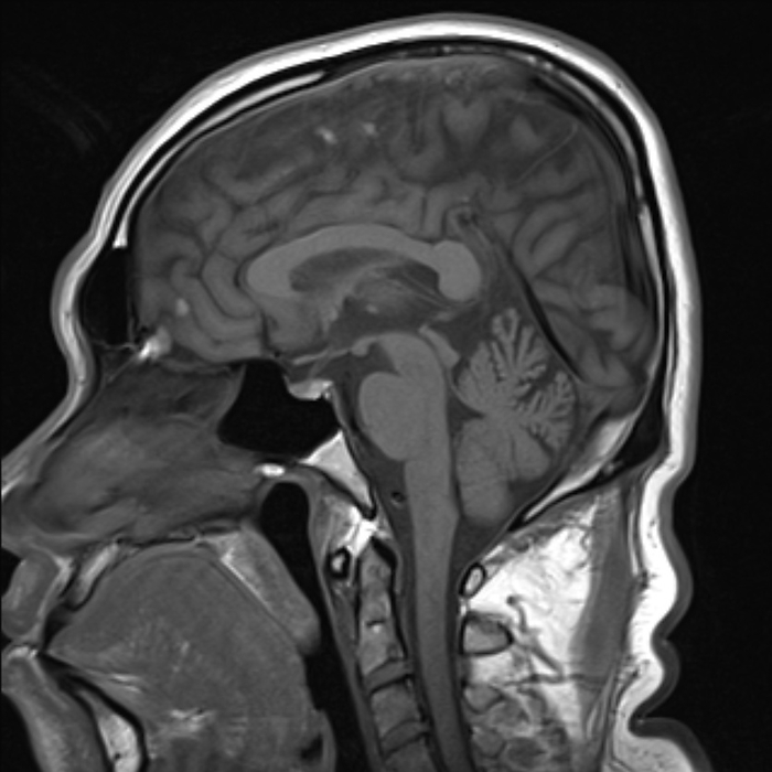 Healthy human brain, MRI scan Sagittal T1 magnetic resonance imaging  MRI  scan of healthy human brain., by RAJAAISYA SCIENCE PHOTO LIBRARY