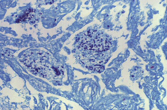 Pneumocystis jirovecii fungus in lung tissue, light micrograph Light micrograph of the single celled fungus Pneumocystis jirovecii  dark blue, ovals  in a lung tissue sample from a patient with pulmonary pneumocystosis. The fungus is present within the alveolar spaces  air sacs  of the lung. P. jirovecii spreads from person to person through the air. Patients on medications such as corticosteroids and immunocompromised patients are at the greatest risk of infection. Symptoms of pulmonary pneumocystosis, also known as pneumocystis pneumonia  PCP , include fever, cough and difficulty breathing. If left untreated PCP can lead to death. Treatment is most often with antibiotics such as trimethoprim or sulfamethoxazole. Sample stained by Grocott s methenamine silver  GMS  method., by CDC SCIENCE PHOTO LIBRARY