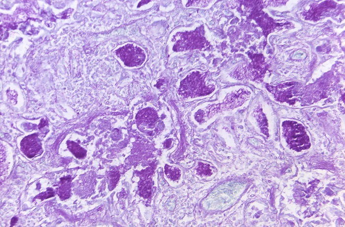 Pneumocystis jirovecii fungus in lung tissue, light micrograph Light micrograph of the single celled fungus Pneumocystis jirovecii  purple ovals  in a lung tissue specimen from a patient with pneumocystis P. jirovecii spreads from the lung tissue specimen from a patient with pneumocystis pneumonia  PCP . Patients on medications such as corticosteroids and immunocompromised patients are at the highest risk of infection. Symptoms of PCP include fever, coughing and difficulty breathing. Treatment is most often with antibiotics such as trimethoprim or sulfamethoxazole. Sample stained by the Periodic acid Schiff  PAS  method. by CDC  SCIENCE PHOTO LIBRARY