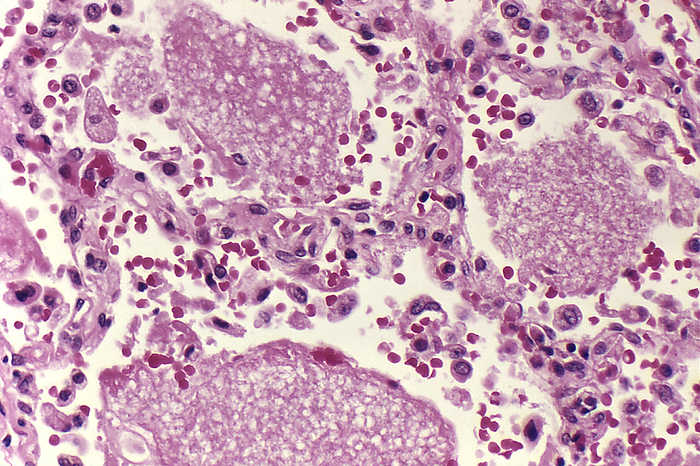 Pneumocystis jirovecii fungus in lung tissue, light micrograph Light micrograph of the single celled fungus Pneumocystis jirovecii  purple ovals  in a lung tissue sample from an AIDS  acquired immune deficiency syndrome  patient with pneumocystosis. The fungus is present within the alveolar spaces  air sacs  of the lung. P. jirovecii spreads from person to person through the air. Patients on medications such as corticosteroids and immunocompromised patients are at the greatest risk of infection. Symptoms of pneumocystosis, also known as pneumocystis pneumonia  PCP , include fever, cough and difficulty breathing. If left untreated PCP can lead to death. Treatment is most often with antibiotics such as trimethoprim or sulfamethoxazole., by CDC SCIENCE PHOTO LIBRARY
