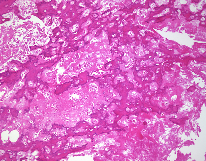 Treated osteosarcoma, light micrograph Treated osteosarcoma. Light micrograph showing necrosis of tumour cells in a treated osteosarcoma  however, the osteoid matrix persists. The current treatment protocols for osteosarcoma consist of neoadjuvant chemotherapy followed by surgical resection. Limb sparing procedures are used whenever feasible. The degree of necrosis following chemotherapy indicates prognosis  the greater the necrosis, the better the prognosis., by WEBPATHOLOGY SCIENCE PHOTO LIBRARY