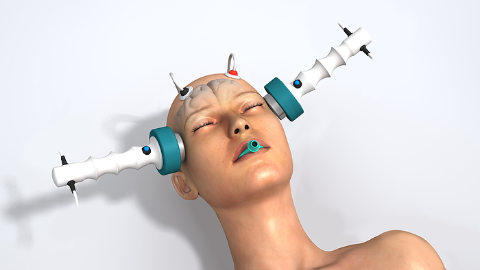 Electroconvulsive therapy, illustration Illustration of a patient undergoing electroconvulsive therapy  ECT . The electrodes placed at the temples will deliver an electrical current that will induce a seizure in the patient s brain. Brain activity is monitored by the electrodes placed above the forehead. ECT is given under a general anaesthetic and the mouth guard prevents the patient from biting their tongue. ECT is used to treat some severe mental illnesses when other treatments haven t helped. It is effective in some cases, although why it works is not fully understood. Use of the treatment can be controversial, especially as in the past it was used while patients were still conscious and often without their consent., by JOSE ANTONIO PE AS SCIENCE PHOTO LIBRARY