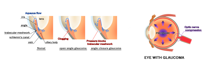 Eyeball cross section of glaucoma
