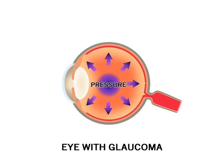 Eyeball cross section of glaucoma