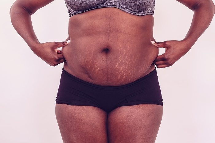 Fat woman with stretch marks on belly, by alimdi / STphotography