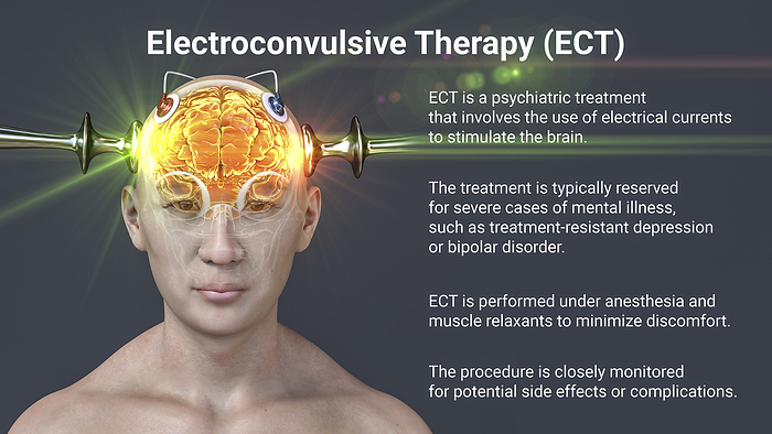Electroconvulsive therapy, illustration Computer illustration of electroconvulsive therapy  ECT , a treatment used for severe mental illnesses involving the use of electrical currents to stimulate the brain., by KATERYNA KON SCIENCE PHOTO LIBRARY