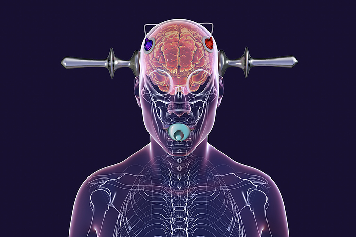 Electroconvulsive therapy, illustration Computer illustration of electroconvulsive therapy  ECT , a treatment used for severe mental illnesses involving the use of electrical currents to stimulate the brain., by KATERYNA KON SCIENCE PHOTO LIBRARY