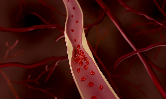 Atherosclerosis, illustration Computer illustration of atherosclerosis. Cholesterol and fat accumulating in arteries leading to blockage  occlusion  of blood vessel., by ARTUR PLAWGO   SCIENCE PHOTO LIBRARY