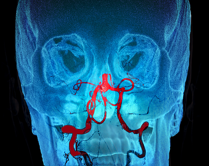 Ischaemic stroke, CT scan Coloured computed tomography  CT  angiogram scan of the head of a 59 year old male patient showing a blocked basilar artery  centre  causing an ischemic stroke or cerebrovascular accident  CVA . The basilar artery is at the back of the brain. An ischemic stroke is caused by a blockage or interruption of the blood supply to the brain. The lack of oxygen  hypoxia  damages the brain. Symptoms depend on the are affected. This blockage caused speech disturbances and weakness on one side of the body  hemiparesis ., by ZEPHYR SCIENCE PHOTO LIBRARY