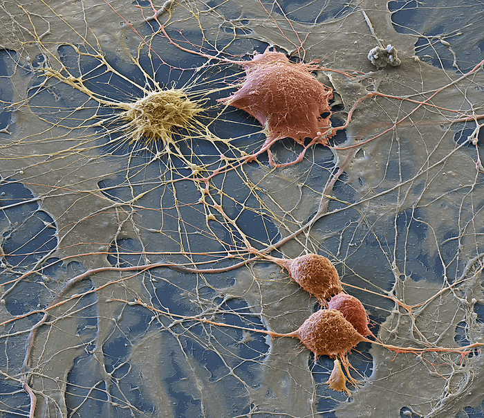Spinal ganglion nerve cells, SEM Coloured scanning electron micrograph  SEM  of four spinal, or dorsal root, ganglion cells  red  that have been grown in culture for 72 hours. A spinal ganglion is a node of nerve cells that is located just outside the spinal cord, along the spinal nerve. These cells are responsible for processing sensory information or for coordinating impulses from other neurons. At upper left is a multipolar glial cell, a non neural cell of the nervous system that provides physical and functional support to neurons. Across the surface are Schwann cells  grey , which secrete myelin, a fatty substance that insulates nerve fibres. The picture was created as part of a cooperation with Quintessenz Publishing. Magnification: x1,500 when printed at 15cm wide., by EYE OF SCIENCE SCIENCE PHOTO LIBRARY
