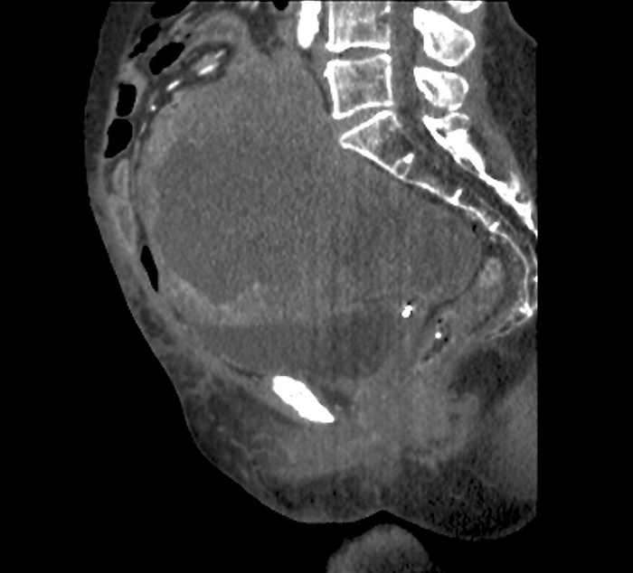 Pelvic tumour, CT scan Computed tomography  CT  scan of the pelvis of a 64 year old female patient showing a large tumour thought to originate from the ovary or uterus  womb ., by ZEPHYR SCIENCE PHOTO LIBRARY