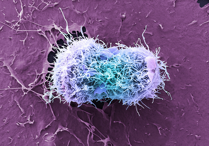 Cervical cancer cells dividing, SEM Cervical cancer cells in late anaphase early telophase stage of cell division, coloured scanning electron micrograph  SEM . The cervix is the lower part of the womb, also called the neck of the womb, and comprises part of the woman s reproductive system. Cervical cancer is more common in younger women. One of the main causes of cervical cancer is a persistent infection of certain types of human papilloma virus  HPV . In cell division the parental cell divides into two daughter cells. Cancer cells often divide and multiply uncontrollably, which can lead to the formation of tumours. Magnification: x2800 when printed at 10 cm wide., by ANNE E. WESTON SCIENCE PHOTO LIBRARY