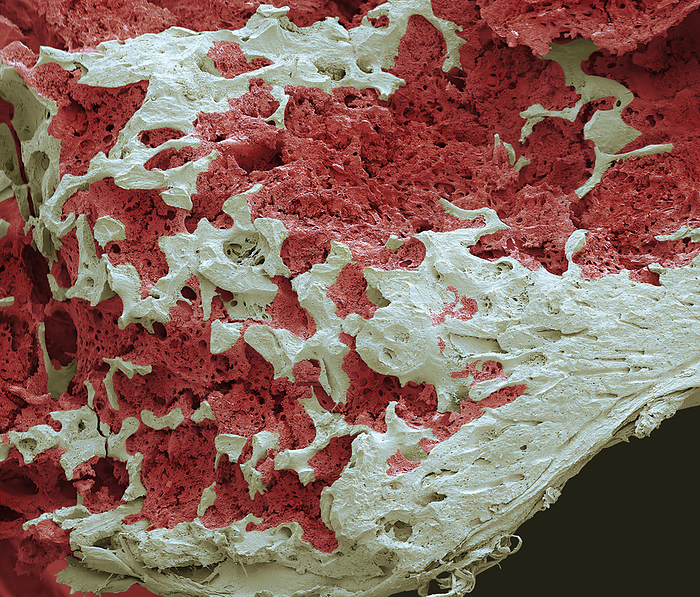 Bone marrow, SEM Bone marrow, scanning electron micrograph  SEM . Bone marrow is the site of blood cell production. Differentiating white and red blood cells  red  are visible surrounded by bone tissue. The white blood cells form part of the body s immune system while the red blood cells carry oxygen around the body. Reticular fibres make up the connective tissue framework of the bone marrow. Compact  or cortical  bone forms the hardened perimeter. Magnification: x300 when printed 10 centimetres wide., by STEVE GSCHMEISSNER SCIENCE PHOTO LIBRARY