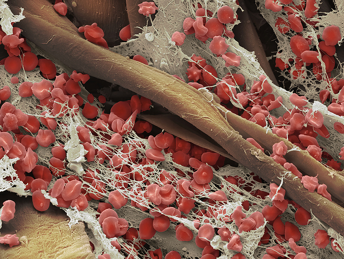 Blood clot on gauze, SEM Blood clot on gauze. Coloured scanning electron micrograph  SEM  of blood clotting on gauze used to dress a wound. Red blood cells  erythrocytes  are trapped in filaments of fibrin protein  cream fine fibers . The fibres of the absorbent material of the gauze are also seen  yellow . When an injury occurs, platelets in the blood stimulate the formation of fibrin filaments, which enmesh platelets and red and white blood cells. The fibrin contracts around them to form a solid clot. Gauze is used to help stop bleeding, and to keep an injury clean and dry during healing or surgery. Magnification: x1000 when printed 10cm wide., by STEVE GSCHMEISSNER SCIENCE PHOTO LIBRARY