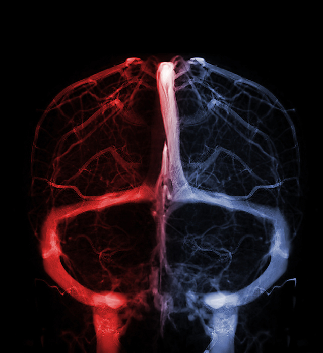 Cerebral  veins, MRV scan Coloured magnetic resonance venography  MRV  scan of healthy cerebral veins., by SAMUNELLA SCIENCE PHOTO LIBRARY