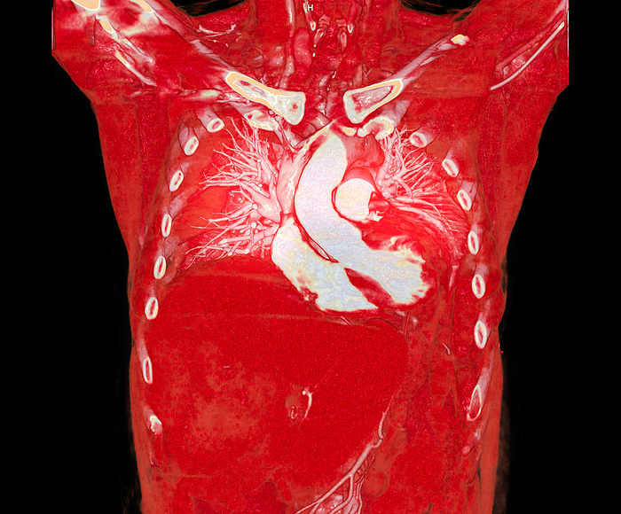 Pulmonary artery, CT scan Coloured 3D computed tomography  CT  angiogram scan of the chest showing the pulmonary artery  white, upper centre . The pulmonary artery carries deoxygenated blood from the heart to the lungs., by SAMUNELLA SCIENCE PHOTO LIBRARY