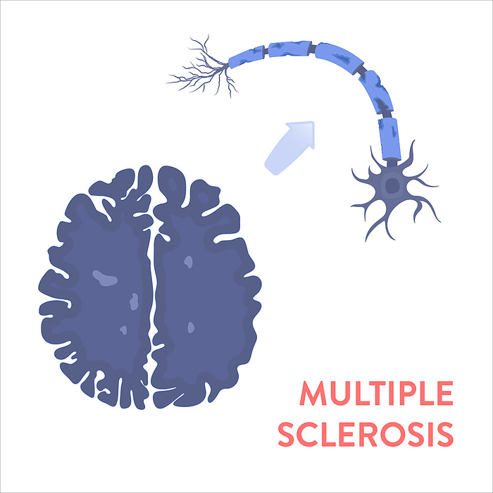 Multiple sclerosis, conceptual illustration Multiple sclerosis, conceptual illustration., by ART4STOCK SCIENCE PHOTO LIBRARY
