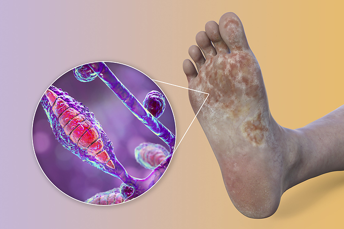 Microsporum canis infection of the foot, illustration Microsporum canis infection of the foot, computer illustration., by KATERYNA KON SCIENCE PHOTO LIBRARY