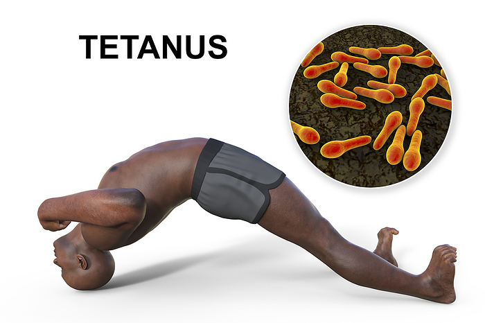 Tetanus, illustration Computer illustration of a man with tetanus, shown in the opisthotonus position, with a close up view of Clostridium tetani bacteria, the causative agent of tetanus., by KATERYNA KON SCIENCE PHOTO LIBRARY
