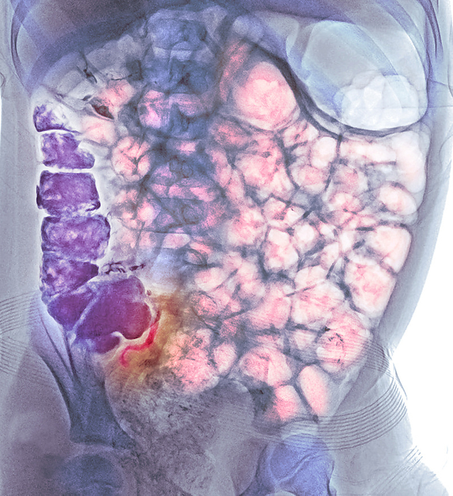 Normal appendicography Coloured normal appendicography. Appendicography is a contrast diagnostic procedure that may be performed in suspected cases of appendicitis. The patient drinks a barium sulphate meal and then undergoes an abdominal X ray 8 hours later. Here the barium contrast material  purple  is filling the caecum, ascending colon and appendix., by RAJAAISYA SCIENCE PHOTO LIBRARY