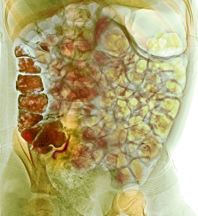 Normal appendicography Coloured normal appendicography. Appendicography is a contrast diagnostic procedure that may be performed in suspected cases of appendicitis. The patient drinks a barium sulphate meal and then undergoes an abdominal X ray 8 hours later. Here the barium contrast material  dark brown  is filling the caecum, ascending colon and appendix., by RAJAAISYA SCIENCE PHOTO LIBRARY