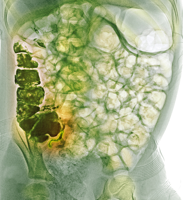 Normal appendicography Coloured normal appendicography. Appendicography is a contrast diagnostic procedure that may be performed in suspected cases of appendicitis. The patient drinks a barium sulphate meal and then undergoes an abdominal X ray 8 hours later. Here the barium contrast material  dark green  is filling the caecum, ascending colon and appendix., by RAJAAISYA SCIENCE PHOTO LIBRARY