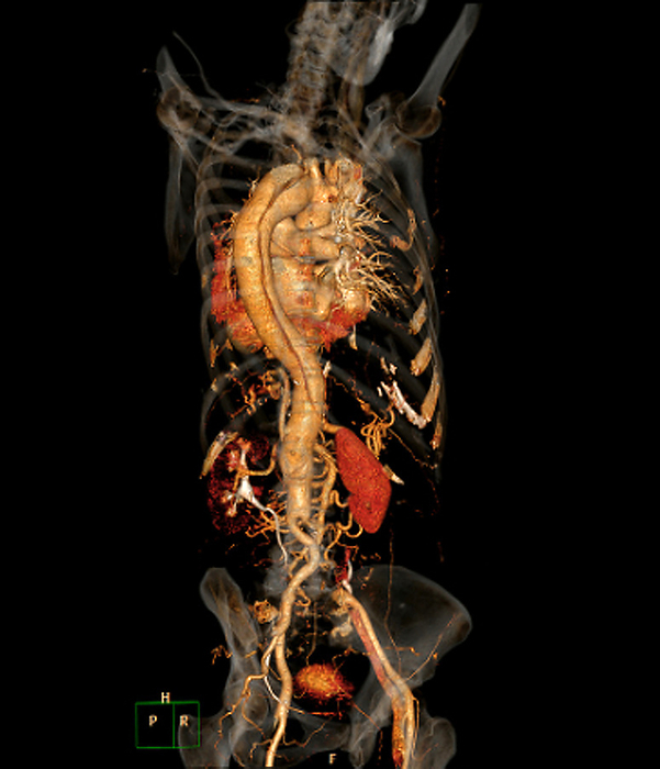 Aortic dissection, CT scan Coloured 3D computed tomography  CT  angiogram scan of the torso of a 62 year old male patient with a dissection of the ascending aorta. This is a tear in the inner lining of the aorta  orange, down centre left , the body s main artery. Blood enters the tear and separates the walls of the aorta, which can lead to a life threatening rupture of the artery. The patient has previously had a right aortoiliac bypass, where  blood flow is redirected through an artificial blood vessel  graft  to the iliac arteries of the pelvis to avoid a blockage. The dissection is preventing the blood from flowing through the graft., by ZEPHYR SCIENCE PHOTO LIBRARY