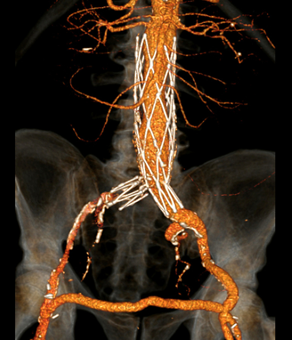 Stent in aortic aneurysm, CT scan Coloured 3D computed tomography  CT  angiogram scan of the abdomen of a 75 year old male patient who has had an aortic aneurysm repaired with a stent  metal mesh, white . The aorta is the body s main artery. An aneurysm is a dilation of the artery wall, and can be fatal if it ruptures. A stent has been implanted in the abdominal region of the aorta above and at the bifurcation of the aorta into the iliac arteries. The patient has also had a femero femoral bypass  horizontal across bottom , where blood flow is redirected through an artificial blood vessel  graft  to avoid a blockage., by ZEPHYR SCIENCE PHOTO LIBRARY