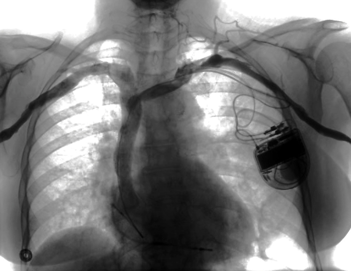Cardiac defibrillator, chest X ray Cardiac defibrillator. X ray of the chest of a 55 year old female patient who has been fitted with an implantable cardioverter defibrillator  ICD, right centre . Wires lead from the defibrillator through the subclavian vein and superior vena cava to the patient s heart. Such devices are used to treat abnormal heart rhythm. If ventricular fibrillation occurs, the device delivers an electrical shock that resets the heart rate to a normal rhythm., by ZEPHYR SCIENCE PHOTO LIBRARY