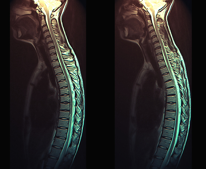 Healthy spine, MRI scans Coloured magnetic resonance imaging  MRI  scans of the healthy spine of a 32 year old male patient., by ZEPHYR SCIENCE PHOTO LIBRARY