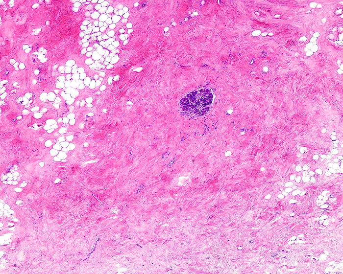 Human breast fibrocystic change, light micrograph Human breast fibrocystic change. Light micrograph of a breast lobule  terminal duct lobular unit  isolated in a fibrous connective tissue stroma. The increase of fibrous tissue manifests as a lumpy, cobblestone texture in the breasts. Breast fibrocystic change is a general term to describe a range of common and benign breast conditions, such as adenosis, fibrosis and cyst formation, which may occur together or in isolation., by JOSE CALVO   SCIENCE PHOTO LIBRARY