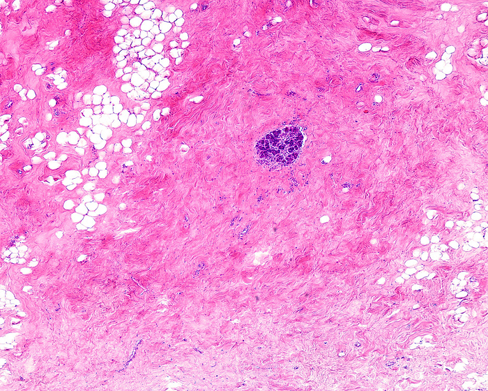 Human breast fibrocystic change, light micrograph Human breast fibrocystic change. Light micrograph of a breast lobule  terminal duct lobular unit  isolated in fibrous connective tissue stroma. Breast fibrocystic change is a general term to describe a range of common and benign  non cancerous  breast conditions, such as adenosis, fibrosis and cyst formation, which may occur together or in isolation. The increase of fibrous tissue manifests as a lumpy, cobblestone texture in the breasts., by JOSE CALVO   SCIENCE PHOTO LIBRARY