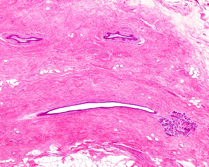 Human breast fibrocystic change, light micrograph Human breast fibrocystic change. Light micrograph of three lactiferous ducts and a lobule isolated in fibrous connective tissue stroma. Breast fibrocystic change is a general term to describe a range of common and benign  non cancerous  breast conditions, such as adenosis, fibrosis and cyst formation, which may occur together or in isolation. The increase of fibrous tissue manifests as a lumpy, cobblestone texture in the breasts., by JOSE CALVO   SCIENCE PHOTO LIBRARY