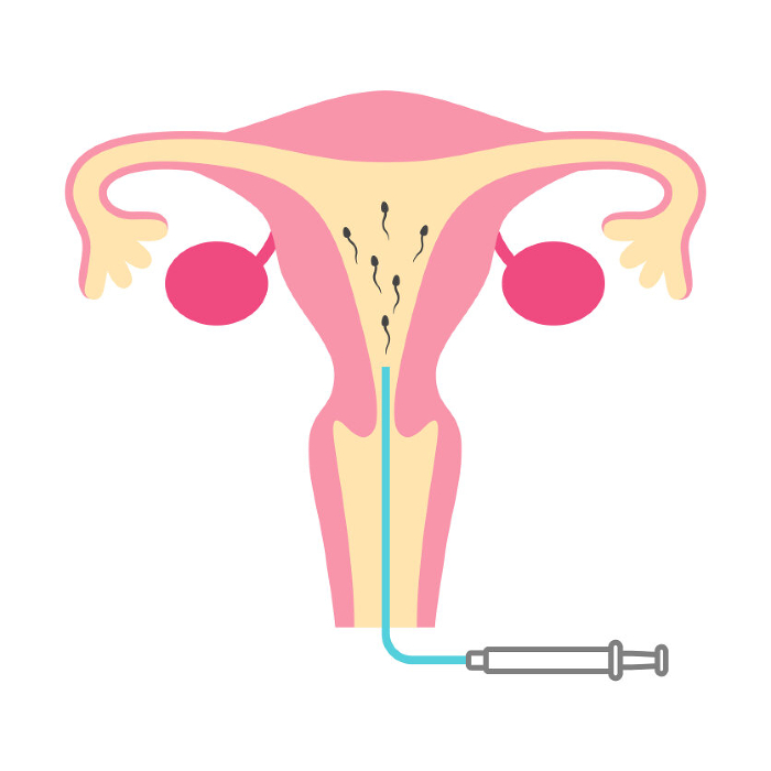 Clip art of artificial insemination