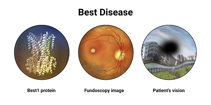 Best vitelliform macular dystrophy, illustration Best vitelliform macular dystrophy. Computer illustration showing the Best1 protein, the classic fundoscopic egg yolk lesion on a retina and distorted vision with and black spot., by KATERYNA KON SCIENCE PHOTO LIBRARY
