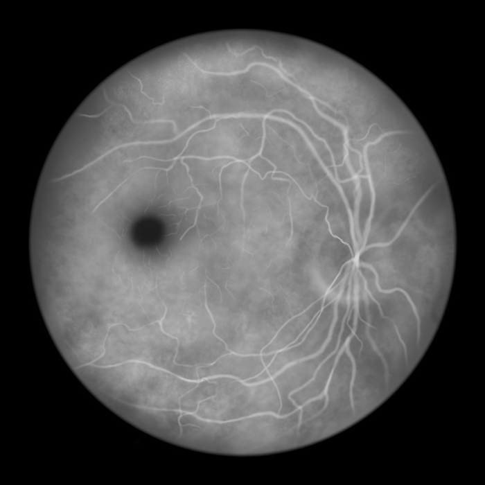 Best vitelliform macular dystrophy, illustration Illustration of a fluorescein angiography view of the vitelliform stage of Best vitelliform macular dystrophy showing the classic egg yolk lesion., by KATERYNA KON SCIENCE PHOTO LIBRARY
