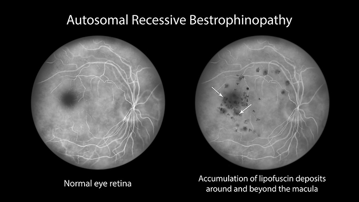 Autosomal recessive bestrophinopathy, illustration Illustration of a fluorescein angiography view of autosomal recessive bestrophinopathy. A normal retina is at left and at right is a retina with an accumulation of lipofuscin deposits around and beyond the macula., by KATERYNA KON SCIENCE PHOTO LIBRARY