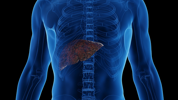 Cirrhotic liver, illustration Cirrhotic liver, illustration., by SEBASTIAN KAULITZKI SCIENCE PHOTO LIBRARY