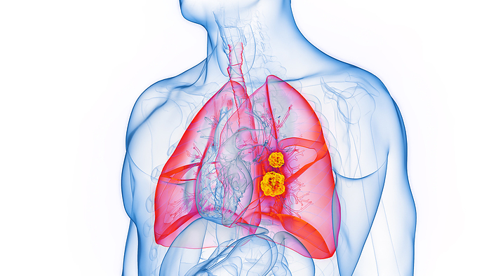 Lung cancer, illustration Lung cancer, illustration., by SEBASTIAN KAULITZKI SCIENCE PHOTO LIBRARY